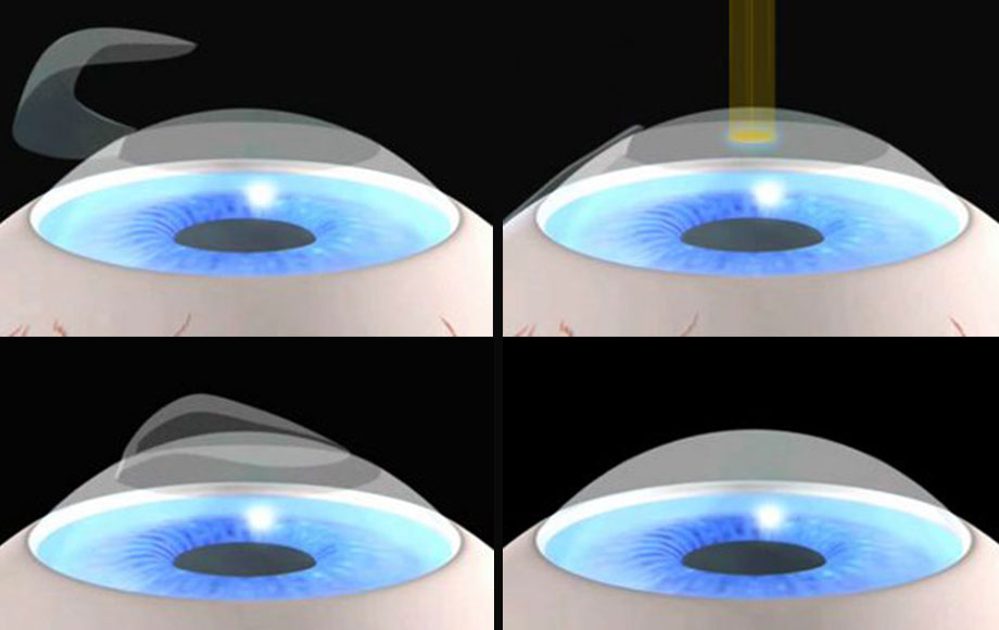 cirugia laser ocular